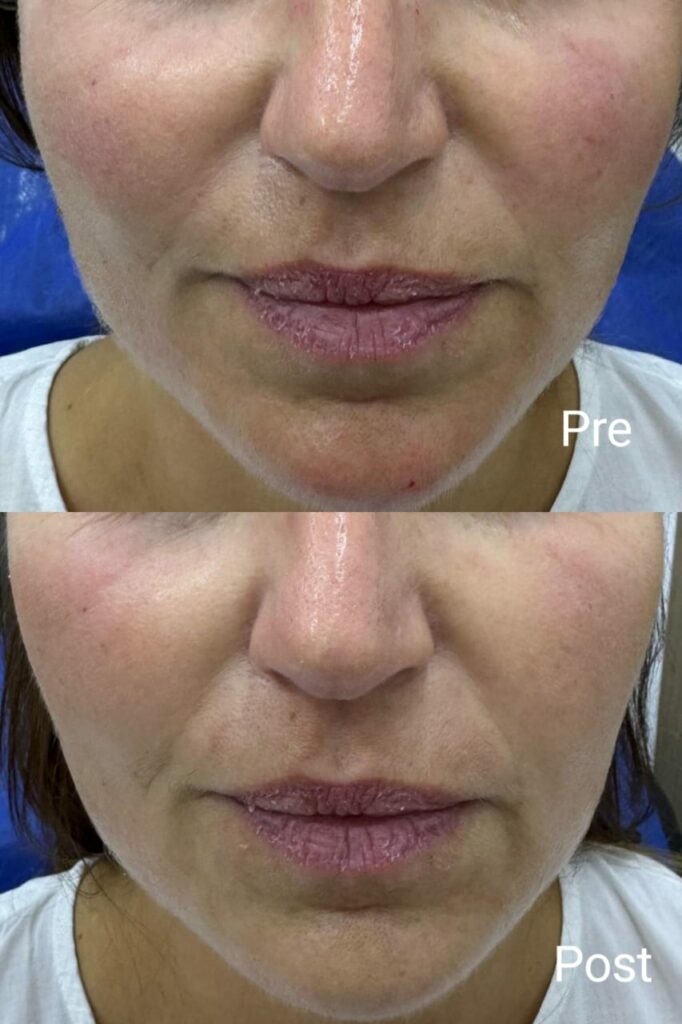 نتائج جلسة فيلر قبل وبعد